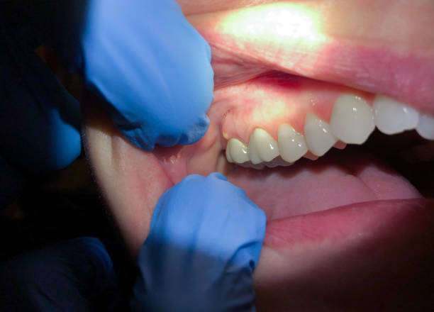 Best Chipped Tooth Repair Near Me  in Knollwood, IL